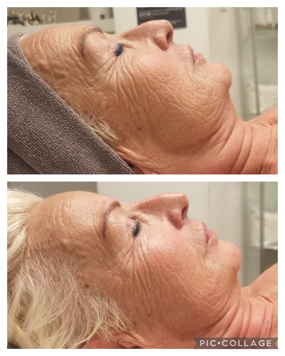 Prima e dopo di un trattamento viso, esempio 1